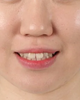교정 전과 비교한 입매 사진