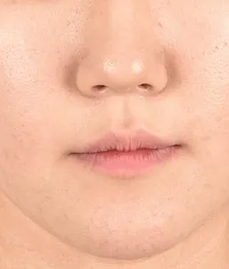 안정적으로 자리잡은 측면 교합