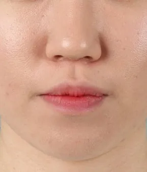 측면에서 본 교합 상태