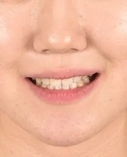 교정 전과 비교한 입매 사진