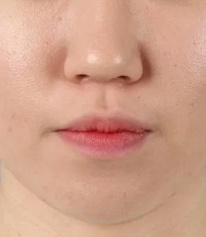 안정적으로 자리잡은 측면 교합