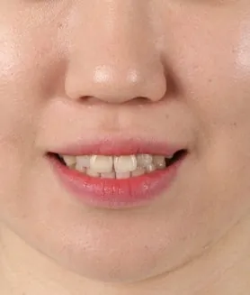측면에서 본 교합 상태