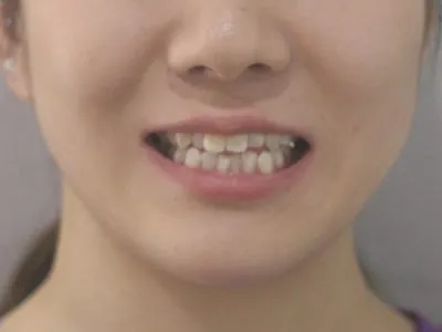 개방교합 교정, 구치부 압하 관련 사진
