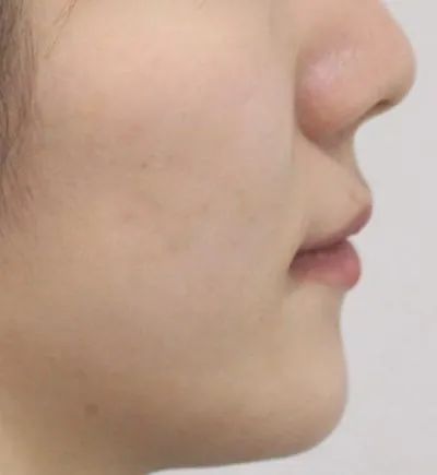 개방교합 교정, 측면 미소 사진