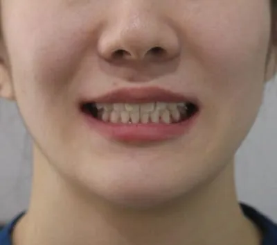 개방교합 교정, 얼굴 변화 관련 사진