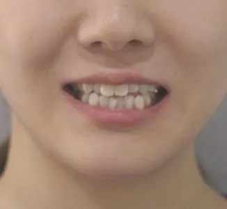 개방교합 교정, 얼굴 변화 관련 사진