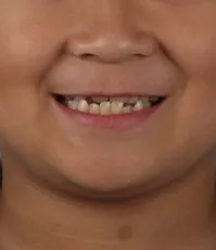 초등학생 주걱턱 교정, 앞니가 거꾸로 물리는 반대교합
