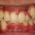 중학생 덧니교정 치료사례 사진