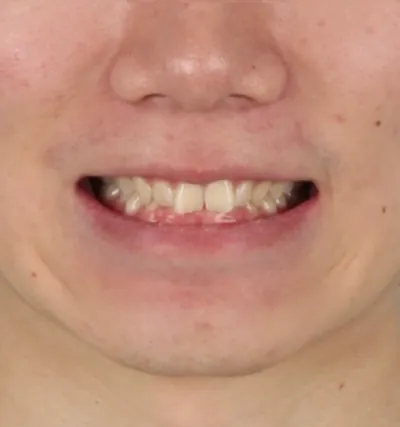 웃거나 말할 때 앞니 노출 모습