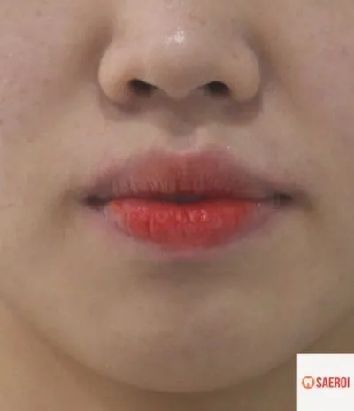 치료 전 앞니 각도·개방교합 사진