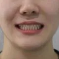 성인 개방교합 케이스 관련 사진