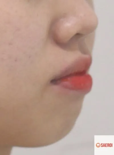 치료 후 치아 배열 사진