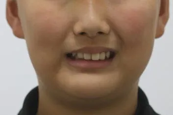 토끼이빨 고민 관련 사진