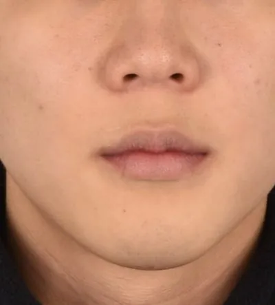 치료 전 아래턱이 길고 나온 얼굴