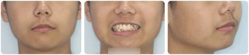 중학생 덧니교정, 놀림받던 아이가 다시 웃게 된 이야기