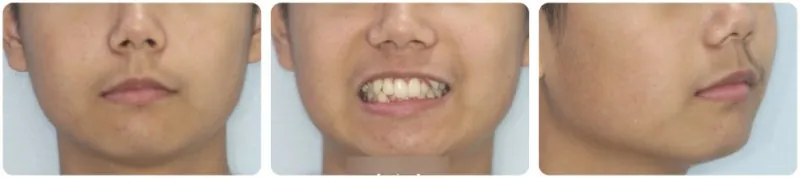 치료 후 웃는 모습 관련 사진