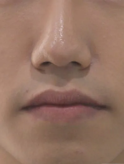 치아보다 입매 고민 관련 검사결과 사진