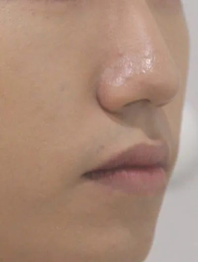 치아보다 입매 고민 관련 검사결과 사진