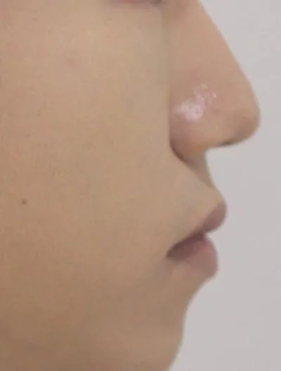 치아보다 입매 고민 관련 검사결과 사진