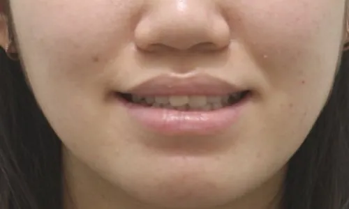 20대 돌출입교정 사례 관련 사진