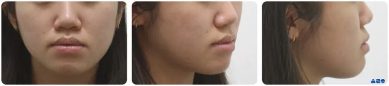 돌출입교정 후 인상 변화 관련 사진