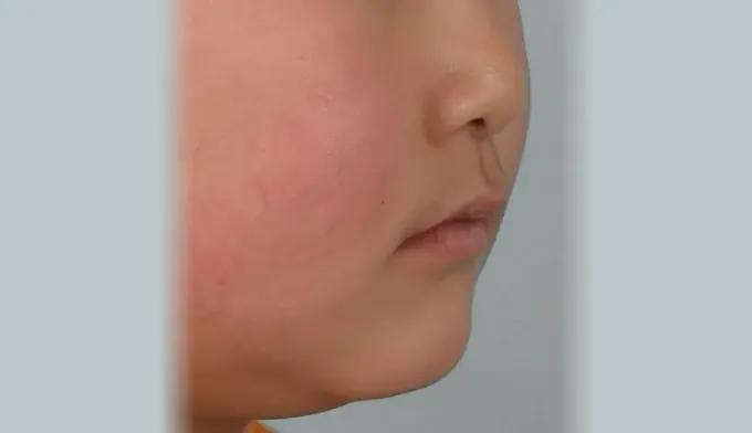 정상적으로 맞물리기 시작한 교합 사진