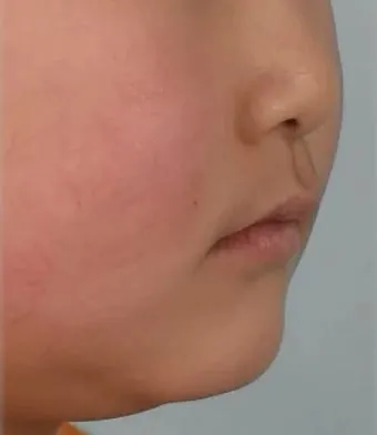 약 4개월 정도 장치를 착용한 뒤 찍은 측면 사진입니다.