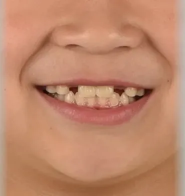 어린이 앞니 반대교합, 근기능장치로 해결한 두 가지 케이스