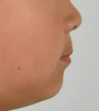 어린이 앞니 반대교합, 근기능장치로 해결한 두 가지 케이스 사진 7