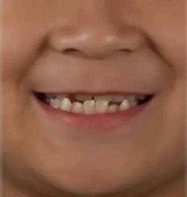교정치료 없이 짧은 기간에 교합이 정상으로 형성되었으며,교합이 바로 잡히…