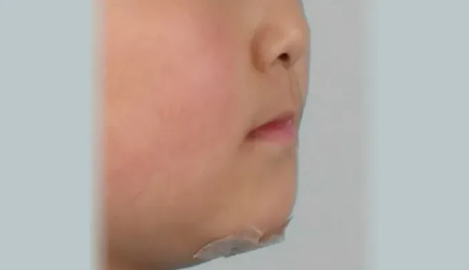 반대교합이 심했던 환자의 치료 전 사진