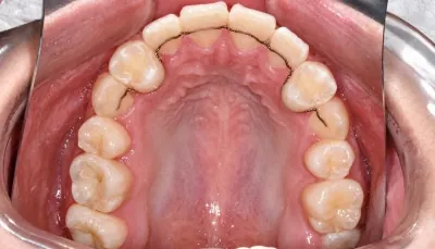 이번 환자분은 안면 비대칭과 주걱턱 경향도 함께 있었기 때문에 앞으로의…