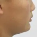 무턱 초등학생 교정, 토끼이빨 케이스 관련 사진