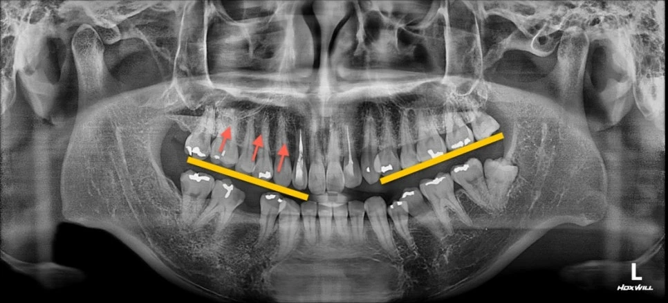 파노라마 X-ray 사진, 좌우 어금니 높이 차이(canting)