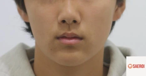 치료 종료 후 정면 안모 사진