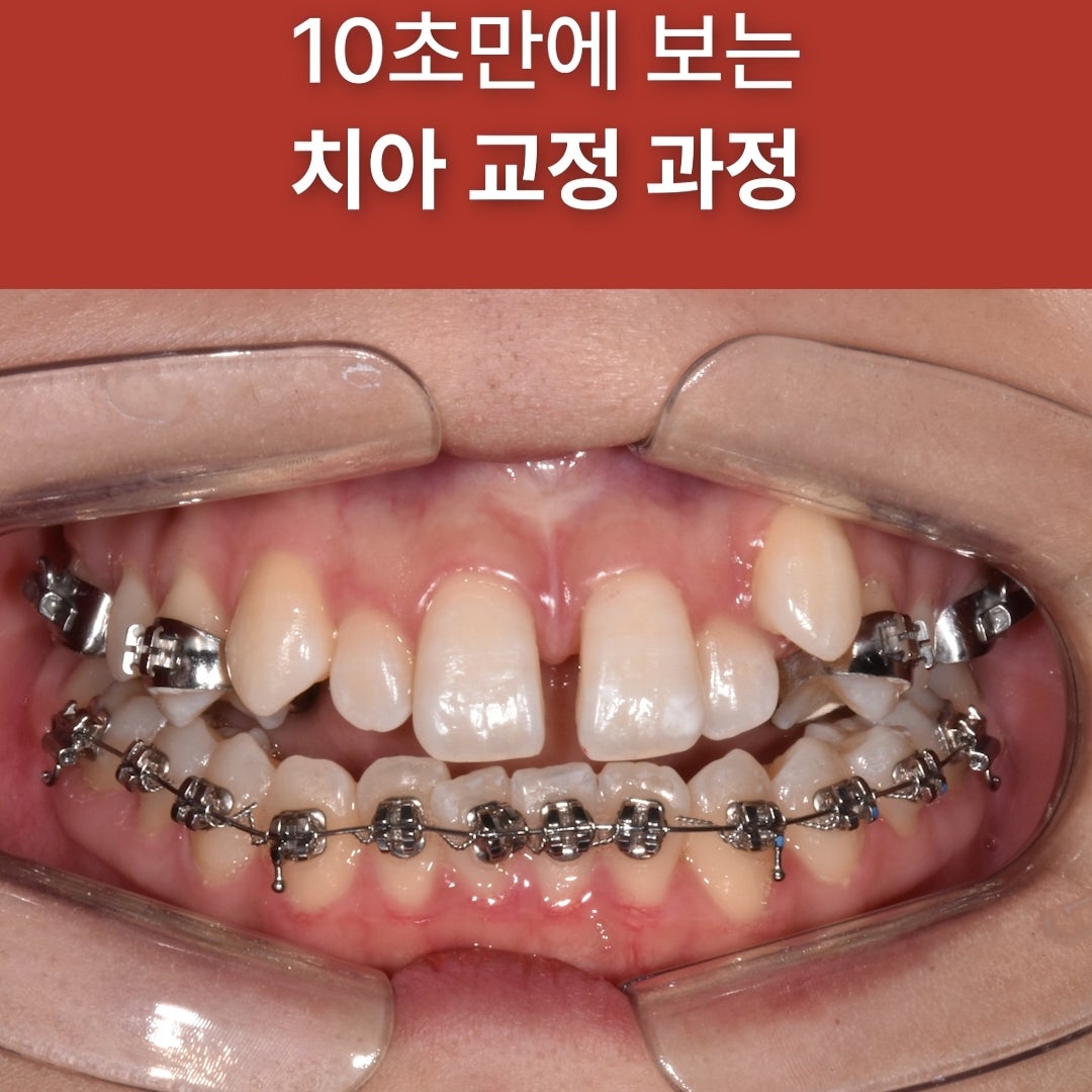 튀어나온 덧니, 교정하면 어떻게 달라질까요? (실제 교정 전후 케이스 요 사진 6