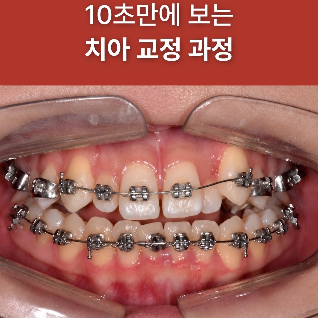 장치 부착과 치아 이동