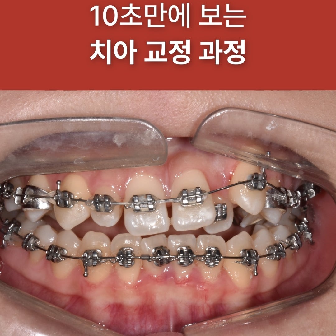 튀어나온 덧니, 교정하면 어떻게 달라질까요? (실제 교정 전후 케이스 요 사진 9