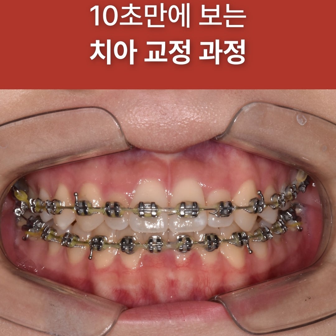 치과 증례 관련 사진