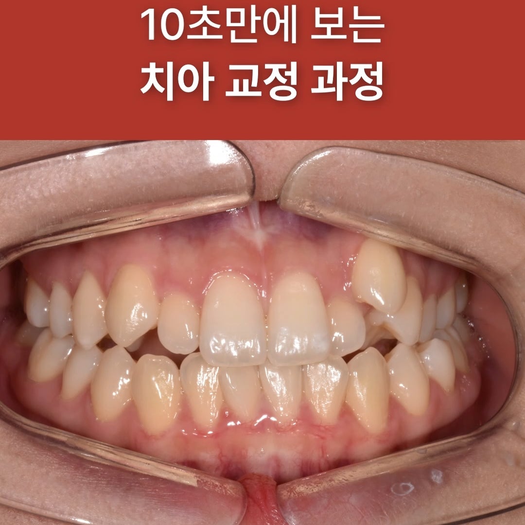 웃을 때 유독 튀어나온 치아가 신경 쓰이시는 분들 계시죠?