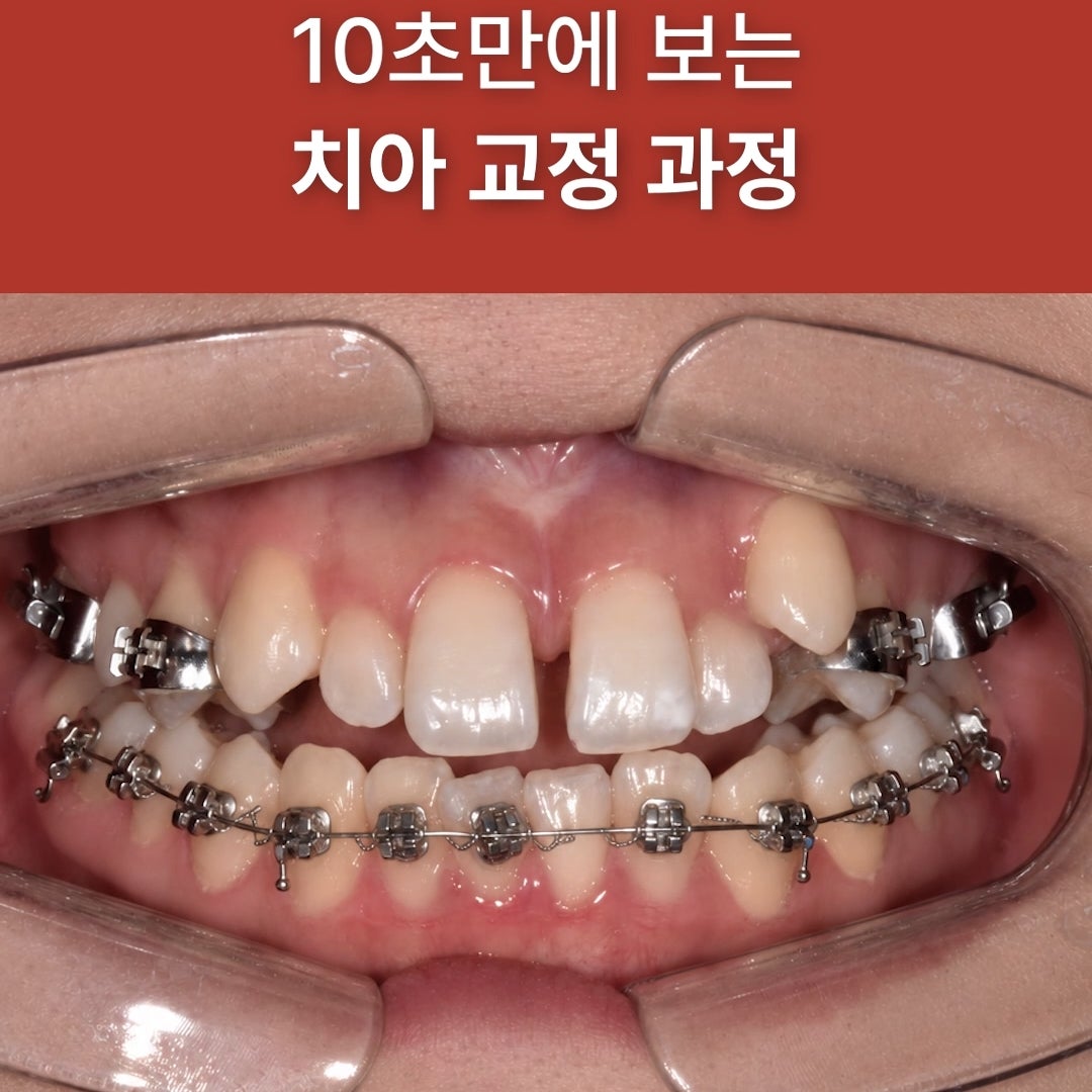 튀어나온 덧니, 교정하면 어떻게 달라질까요? (실제 교정 전후 케이스 요 사진 5