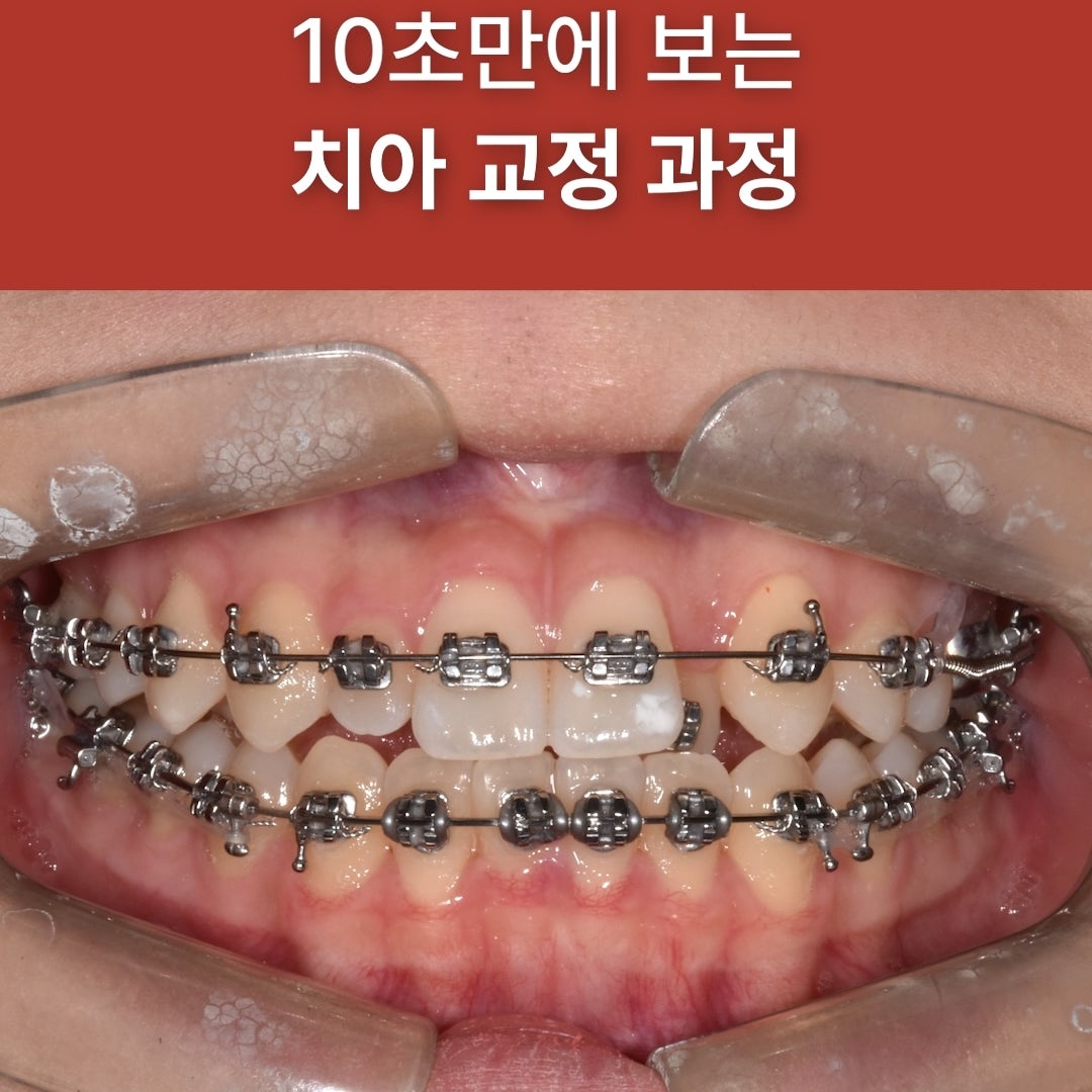 튀어나온 덧니, 교정하면 어떻게 달라질까요? (실제 교정 전후 케이스 요 사진 10