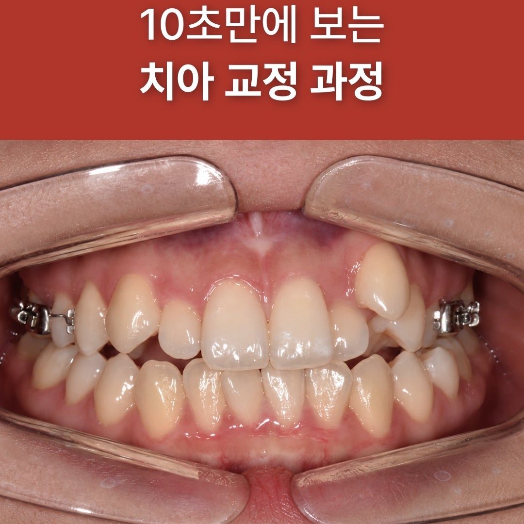 교정 전 덧니 상태